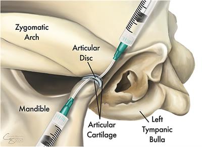 Management of Septic Arthritis of the Temporomandibular Joint in Dogs